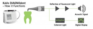 DIAGNOdent uses a laser diode to inspect your teeth.