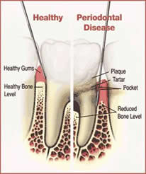 Gum and bone conditions