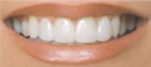 Porcelain veneers are a great option to improve a smile.