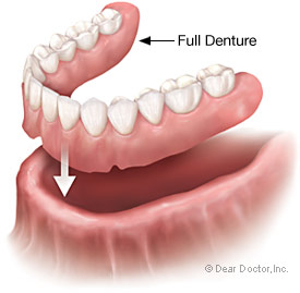 A common denture application is a full denture.