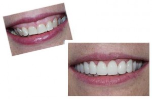 Fix a gummy smile at Dental Health Colorado