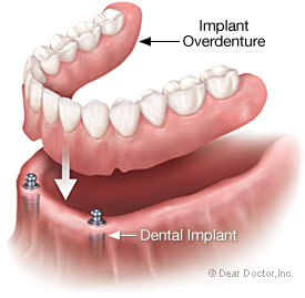 New technologies in dentures include implants.