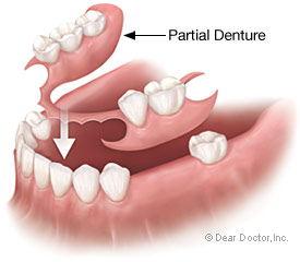One option in dentures is a partial denture.