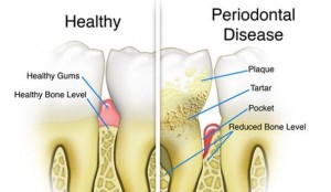 Dangerous oral bacteria lives in periodontal pockets underneath the gums