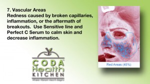 This image contains a description of Vascular Areas of the Skin.
